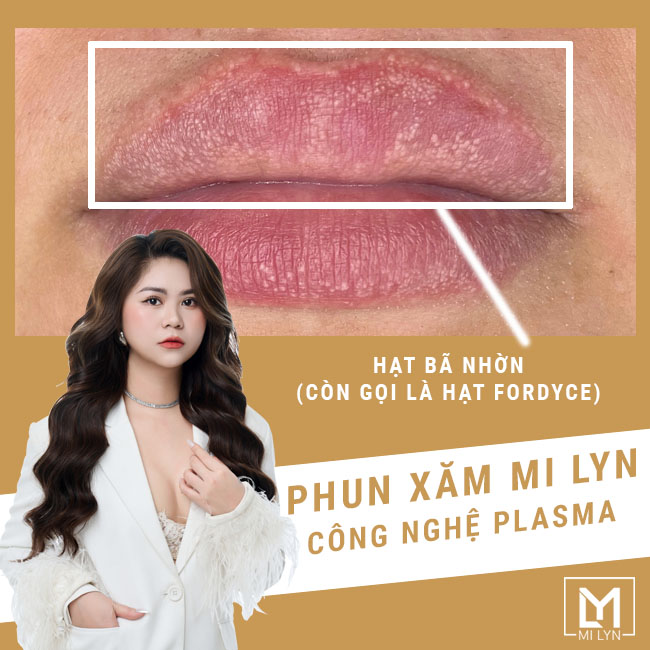 xÓA hạt fordyce bã nhờn ở hải phòng bằng plasma