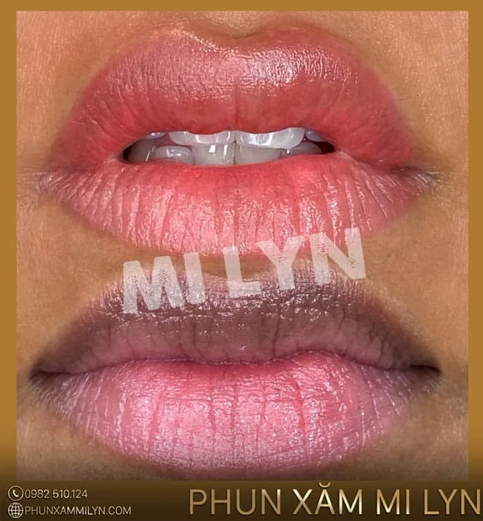 Địa chỉ khử thâm môi nam hải phòng