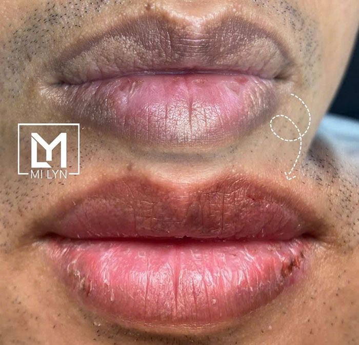 Khử thâm môi nam đẹp tự nhiên mi lyn hải phòng