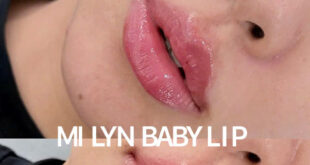 Tiêm môi baby filler Hải Phòng