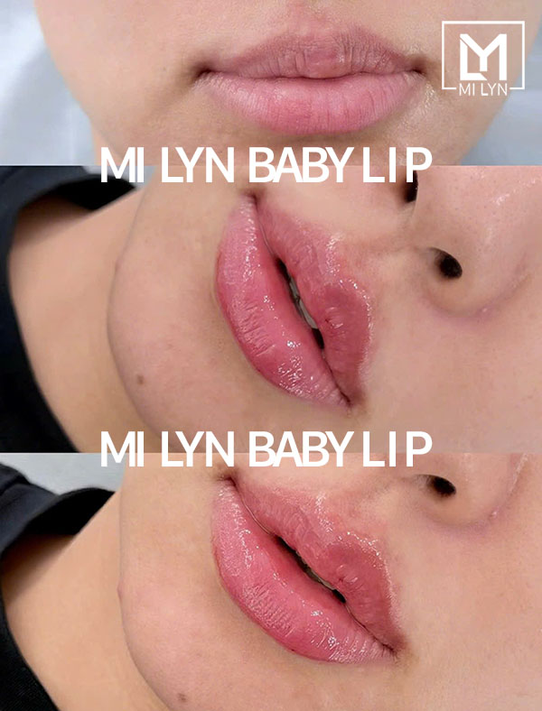 Tiêm môi baby filler Hải Phòng