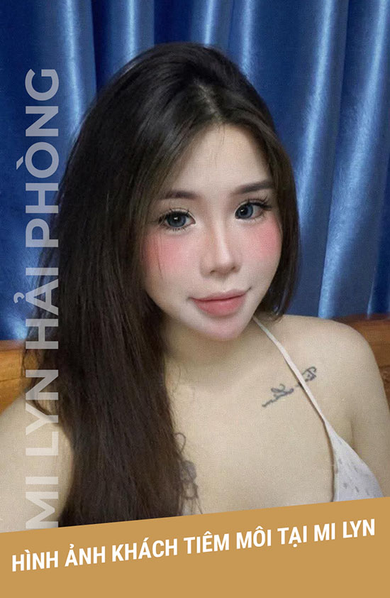 Mi lyn địa chỉ tiêm filler môi hải phòng