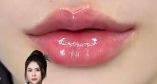 MI LYN ĐỊA CHỈ TIÊM MÔI FILLER BOTOX UY TÍN HẢI PHÒNG