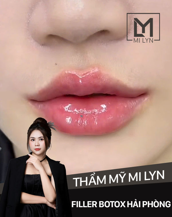 MI LYN ĐỊA CHỈ TIÊM MÔI FILLER BOTOX UY TÍN HẢI PHÒNG